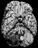 Right posterior inferior cerebellar artery infarct